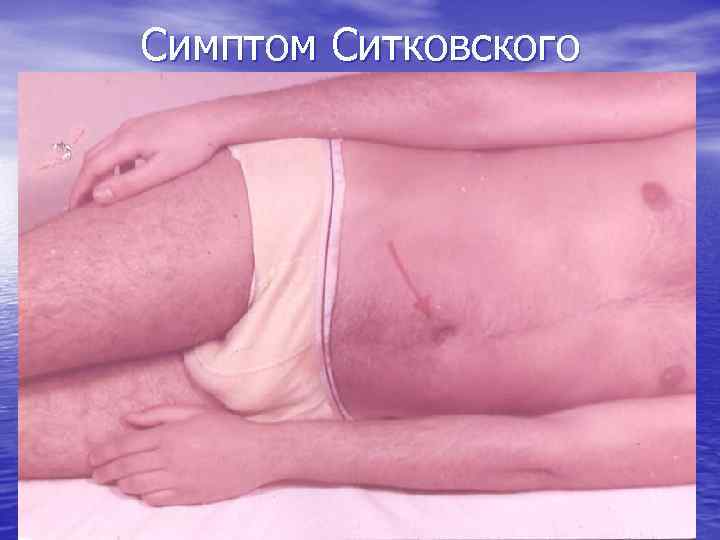 Симптом Ситковского 