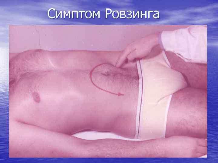 Симптом Ровзинга 