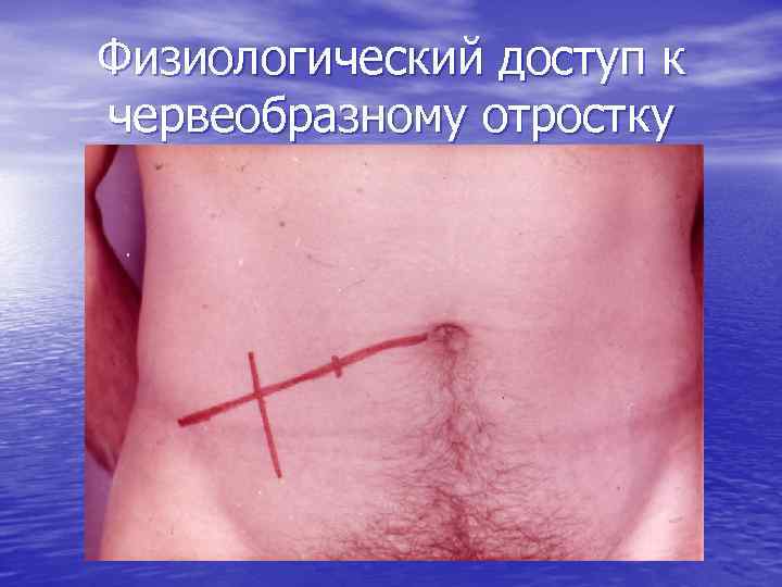 Физиологический доступ к червеобразному отростку 