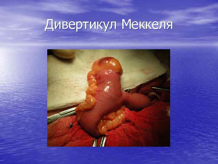 Дивертикул Меккеля 