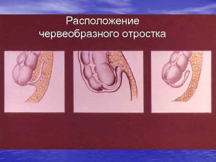 Расположение червеобразного отростка 