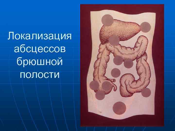 Осложнения аппендицита