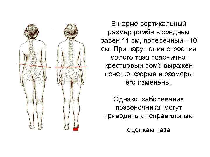 В норме вертикальный размер ромба в среднем равен 11 см, поперечный 10 см. При