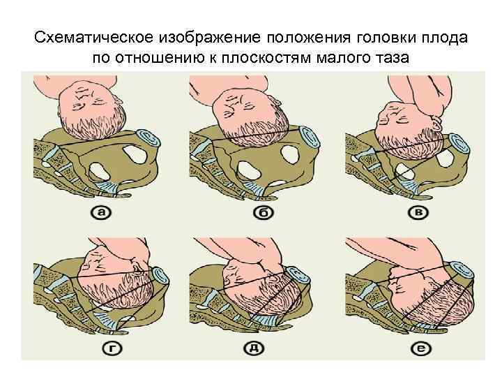 Схематическое изображение положения головки плода по отношению к плоскостям малого таза 