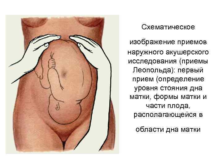 Схематическое изображение приемов наружного акушерского исследования (приемы Леопольда): первый прием (определение уровня стояния дна