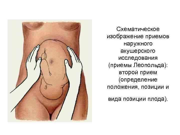 Схематическое изображение приемов наружного акушерского исследования (приемы Леопольда): второй прием (определение положения, позиции и
