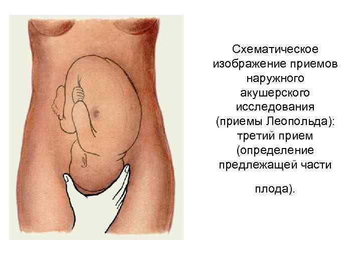 Схематическое изображение приемов наружного акушерского исследования (приемы Леопольда): третий прием (определение предлежащей части плода).