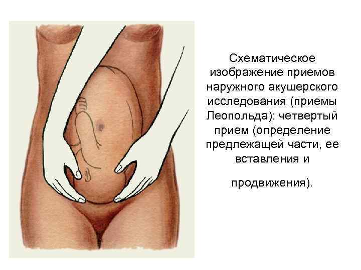 Схематическое изображение приемов наружного акушерского исследования (приемы Леопольда): четвертый прием (определение предлежащей части, ее