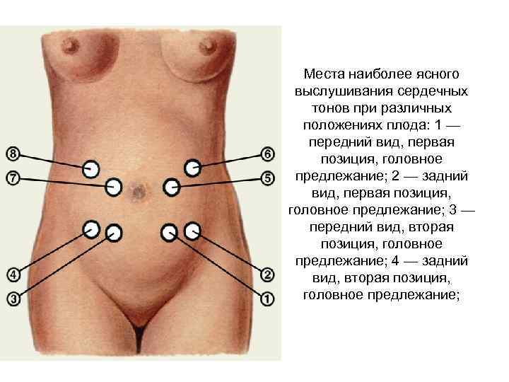 Места наиболее ясного выслушивания сердечных тонов при различных положениях плода: 1 — передний вид,