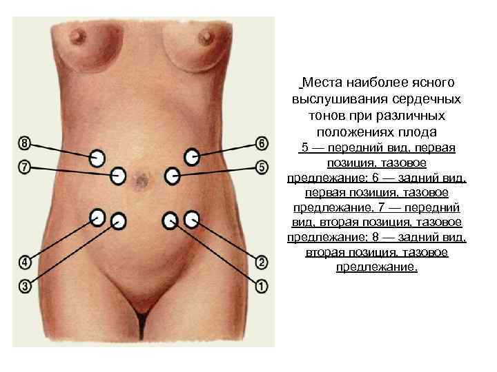  Места наиболее ясного выслушивания сердечных тонов при различных положениях плода 5 — передний
