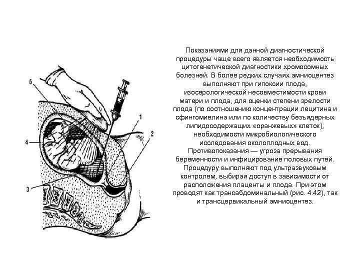 Показаниями для данной диагностической процедуры чаще всего является необходимость цитогенетической диагностики хромосомных болезней. В