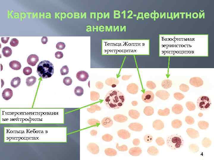 Картина крови при В 12 -дефицитной анемии Тельца Жолли в эритроцитах Базофильная зернистость эритроцитов