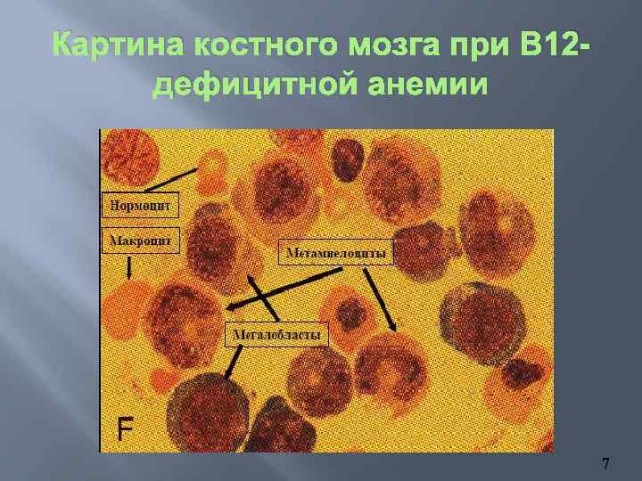 Картина костного мозга при В 12 дефицитной анемии 7 