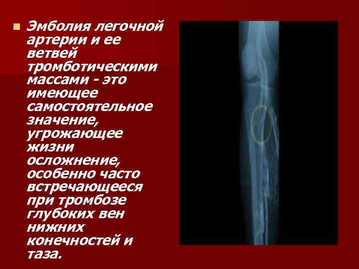 n Эмболия легочной артерии и ее ветвей тромботическими массами - это имеющее самостоятельное значение,