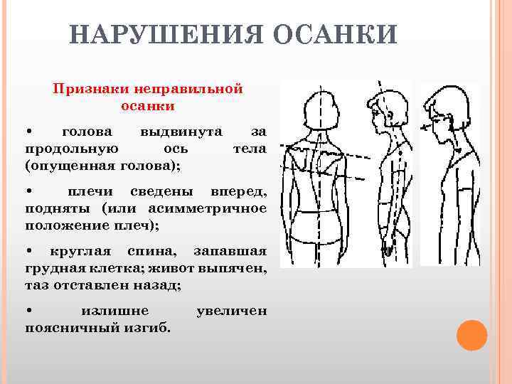 НАРУШЕНИЯ ОСАНКИ Признаки неправильной осанки • голова выдвинута за продольную ось тела (опущенная голова);