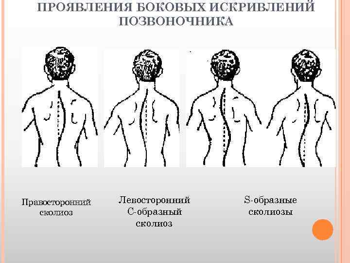 ПРОЯВЛЕНИЯ БОКОВЫХ ИСКРИВЛЕНИЙ ПОЗВОНОЧНИКА Правосторонний сколиоз Левосторонний С образный сколиоз S образные сколиозы 