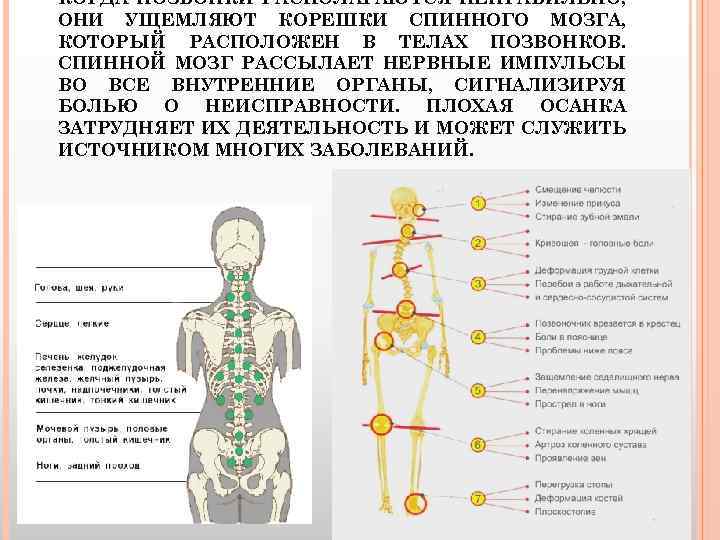 КОГДА ПОЗВОНКИ РАСПОЛАГАЮТСЯ НЕПРАВИЛЬНО, ОНИ УЩЕМЛЯЮТ КОРЕШКИ СПИННОГО МОЗГА, КОТОРЫЙ РАСПОЛОЖЕН В ТЕЛАХ ПОЗВОНКОВ.