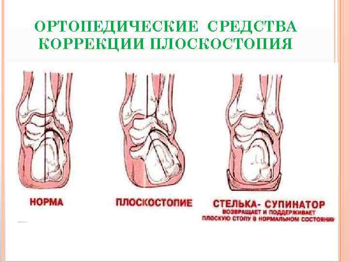 ОРТОПЕДИЧЕСКИЕ СРЕДСТВА КОРРЕКЦИИ ПЛОСКОСТОПИЯ 