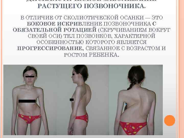 ДИСПЛАСТИЧЕСКОЕ ЗАБОЛЕВАНИЕ РАСТУЩЕГО ПОЗВОНОЧНИКА. В ОТЛИЧИЕ ОТ СКОЛИОТИЧЕСКОЙ ОСАНКИ — ЭТО БОКОВОЕ ИСКРИВЛЕНИЕ ПОЗВОНОЧНИКА