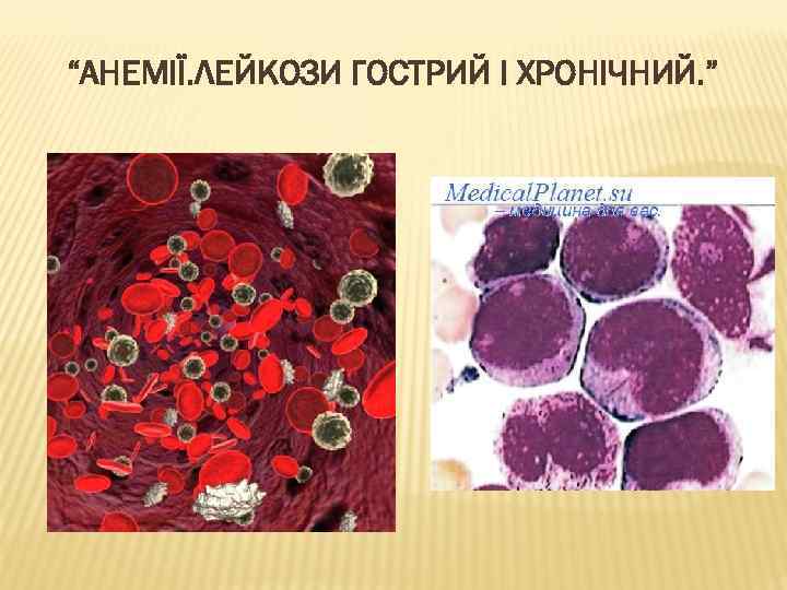 “АНЕМІЇ. ЛЕЙКОЗИ ГОСТРИЙ І ХРОНІЧНИЙ. ” 