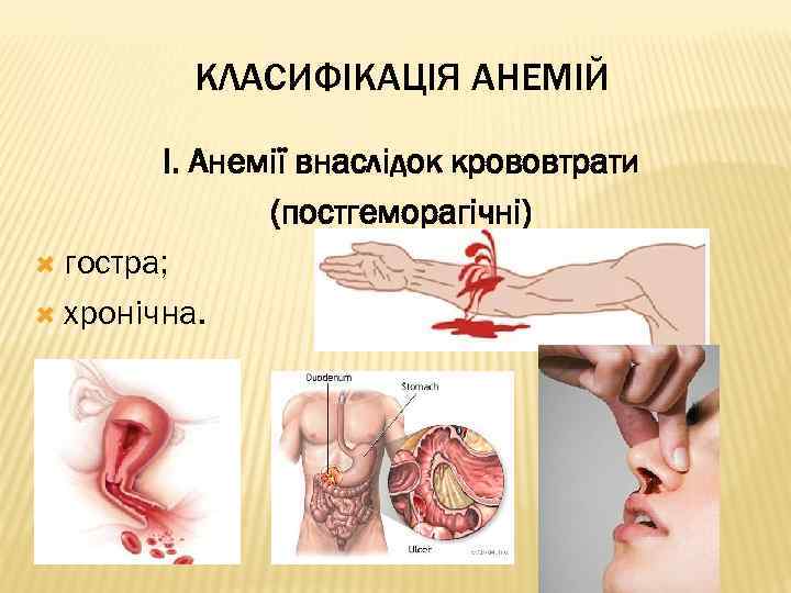 КЛАСИФІКАЦІЯ АНЕМІЙ І. Анемії внаслідок крововтрати (постгеморагічні) гостра; хронічна. 