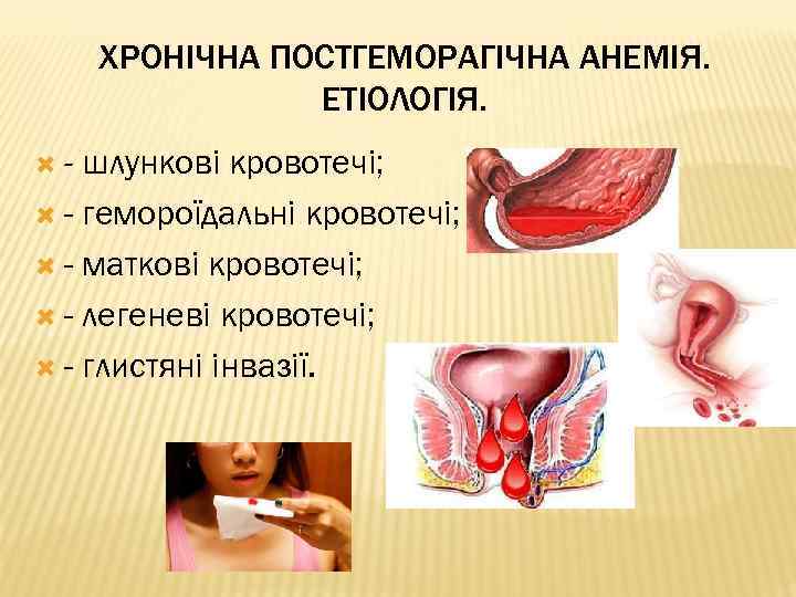ХРОНІЧНА ПОСТГЕМОРАГІЧНА АНЕМІЯ. ЕТІОЛОГІЯ. - шлункові кровотечі; - гемороїдальні кровотечі; - маткові кровотечі; -