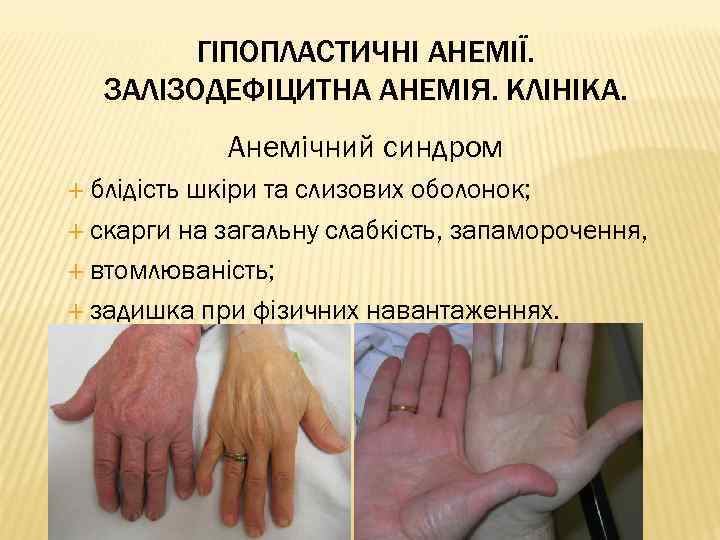 ГІПОПЛАСТИЧНІ АНЕМІЇ. ЗАЛІЗОДЕФІЦИТНА АНЕМІЯ. КЛІНІКА. Анемічний синдром блідість шкіри та слизових оболонок; скарги на