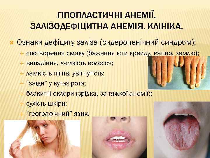 ГІПОПЛАСТИЧНІ АНЕМІЇ. ЗАЛІЗОДЕФІЦИТНА АНЕМІЯ. КЛІНІКА. Ознаки дефіциту заліза (сидеропенічний синдром): спотворення смаку (бажання їсти
