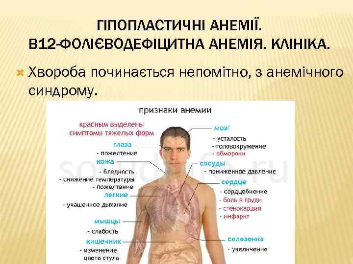 ГІПОПЛАСТИЧНІ АНЕМІЇ. В 12 -ФОЛІЄВОДЕФІЦИТНА АНЕМІЯ. КЛІНІКА. Хвороба починається непомітно, з анемічного синдрому. 