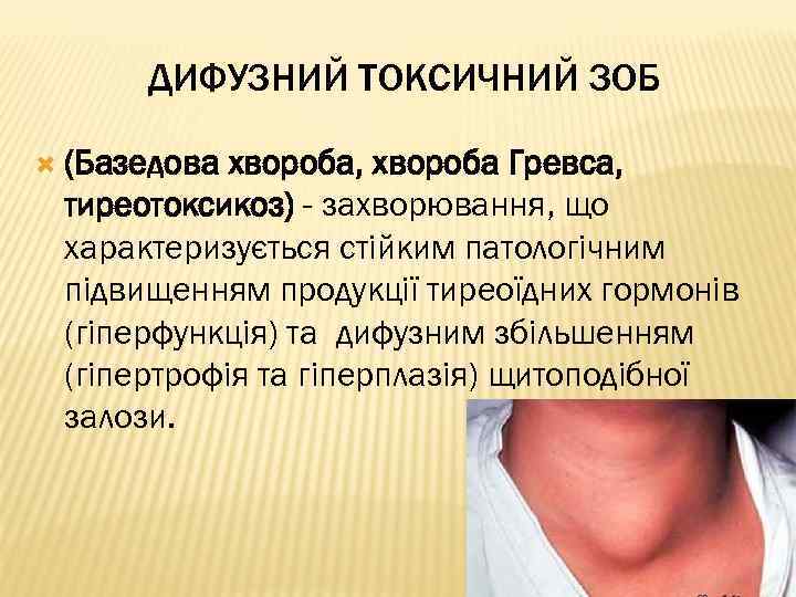 ДИФУЗНИЙ ТОКСИЧНИЙ ЗОБ (Базедова хвороба, хвороба Гревса, тиреотоксикоз) - захворювання, що характеризується стійким патологічним