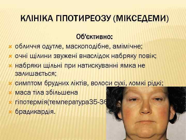 КЛІНІКА ГІПОТИРЕОЗУ (МІКСЕДЕМИ) Об'єктивно: обличчя одутле, маскоподібне, амімічне; очні щілини звужені внаслідок набряку повік;