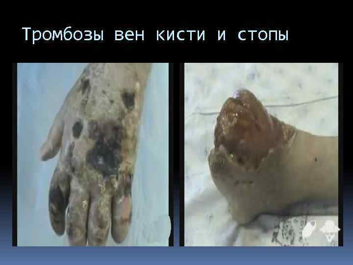 Тромбозы вен кисти и стопы 