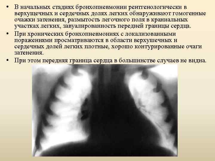  • В начальных стадиях бронхопневмонии рентгенологически в верхущечных и сердечных долях легких обнаруживают