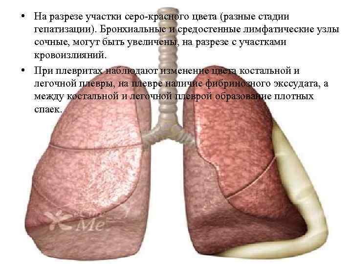 Бронхопневмония карта вызова