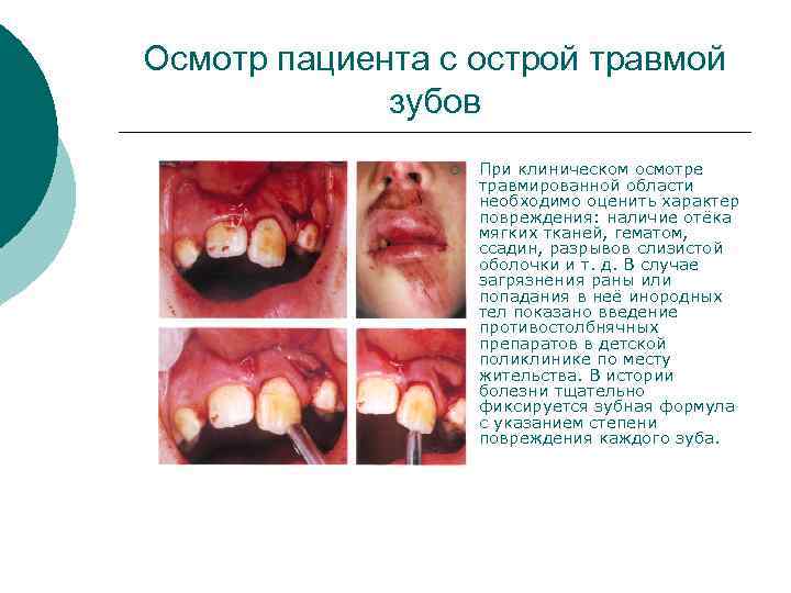 Осмотр пациента с острой травмой зубов ¡ При клиническом осмотре травмированной области необходимо оценить