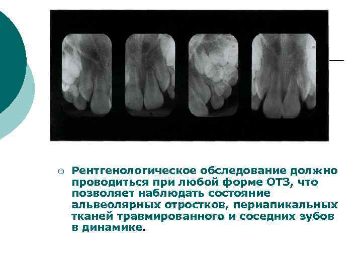 ¡ Рентгенологическое обследование должно проводиться при любой форме ОТЗ, что позволяет наблюдать состояние альвеолярных