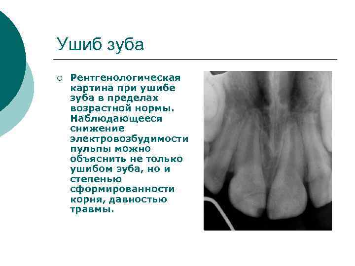 Ушиб зуба ¡ Рентгенологическая картина при ушибе зуба в пределах возрастной нормы. Наблюдающееся снижение