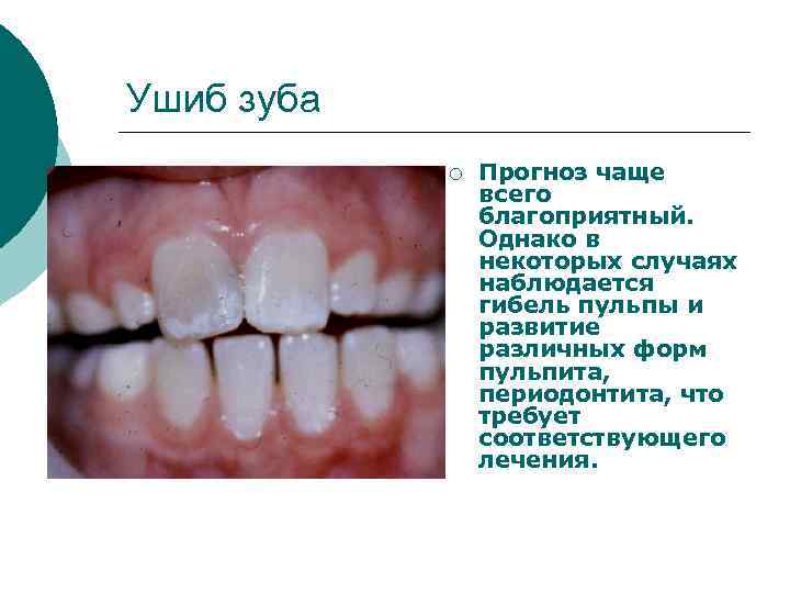 Ушиб зуба ¡ Прогноз чаще всего благоприятный. Однако в некоторых случаях наблюдается гибель пульпы