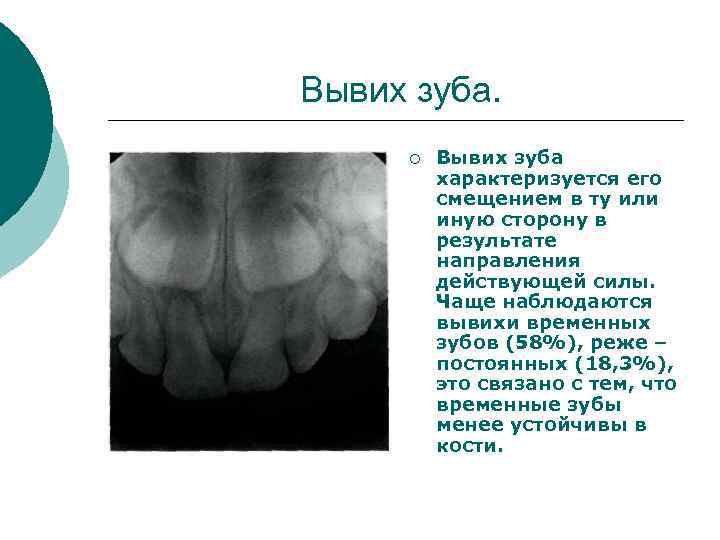 Вывих зуба. ¡ Вывих зуба характеризуется его смещением в ту или иную сторону в