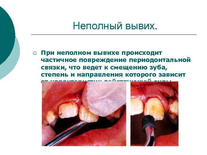 Неполный вывих. ¡ При неполном вывихе происходит частичное повреждение периодонтальной связки, что ведет к