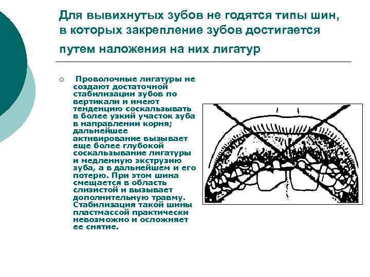 Для вывихнутых зубов не годятся типы шин, в которых закрепление зубов достигается путем наложения