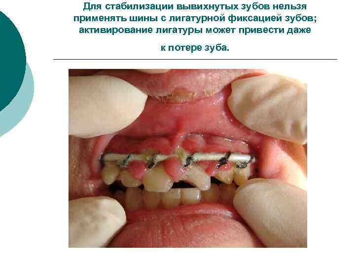 Для стабилизации вывихнутых зубов нельзя применять шины с лигатурной фиксацией зубов; активирование лигатуры может