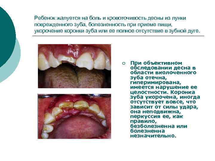 Ребенок жалуется на боль и кровоточивость десны из лунки поврежденного зуба, болезненность приеме пищи,