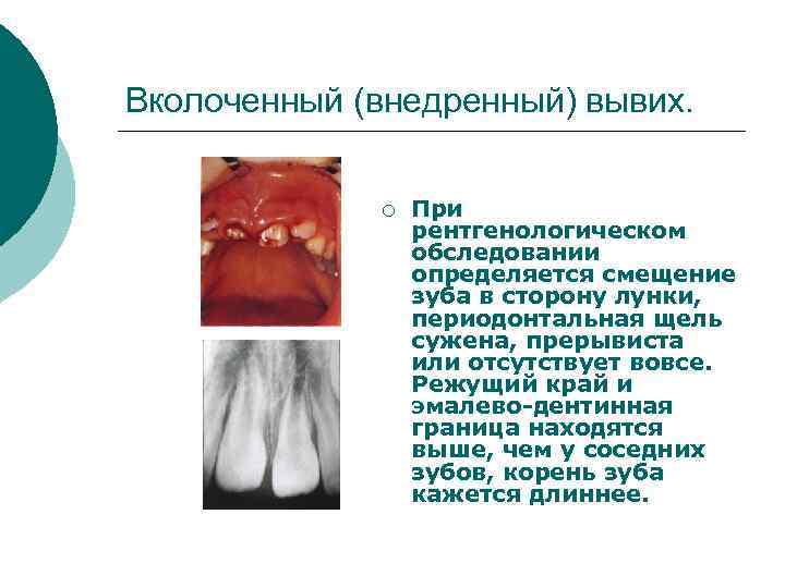 Вколоченный (внедренный) вывих. ¡ При рентгенологическом обследовании определяется смещение зуба в сторону лунки, периодонтальная