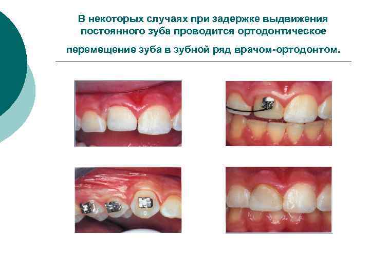 В некоторых случаях при задержке выдвижения постоянного зуба проводится ортодонтическое перемещение зуба в зубной