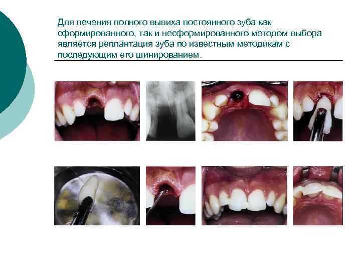 Для лечения полного вывиха постоянного зуба как сформированного, так и несформированного методом выбора является