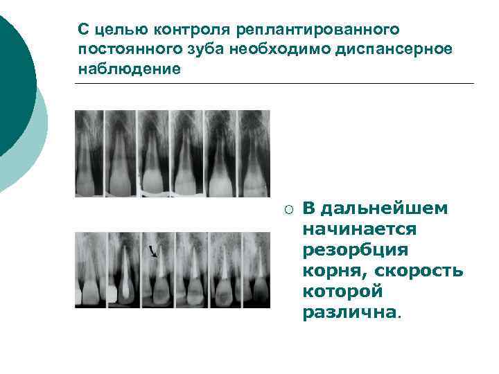 С целью контроля реплантированного постоянного зуба необходимо диспансерное наблюдение ¡ В дальнейшем начинается резорбция