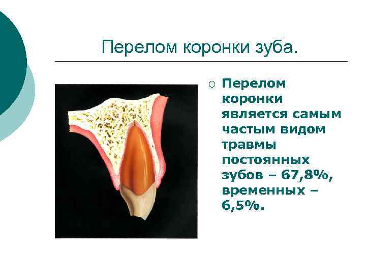 Перелом коронки зуба. ¡ Перелом коронки является самым частым видом травмы постоянных зубов –