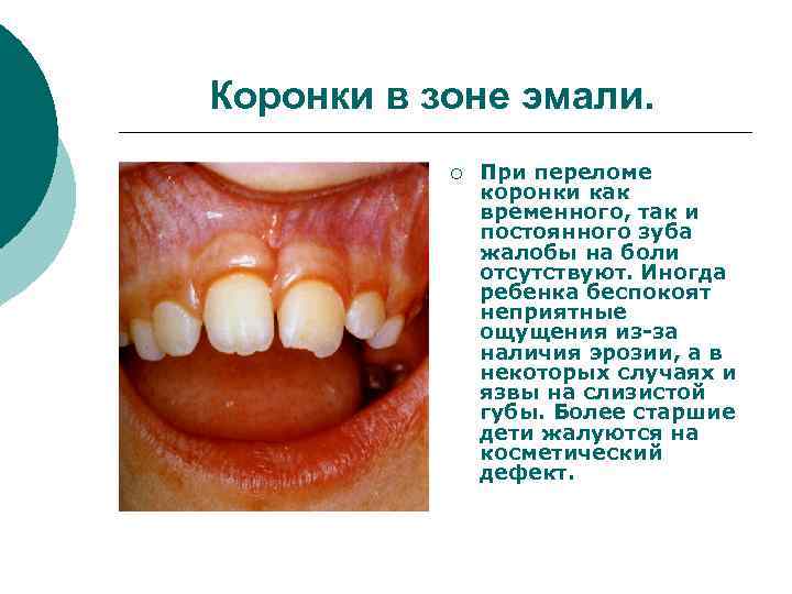 Коронки в зоне эмали. ¡ При переломе коронки как временного, так и постоянного зуба