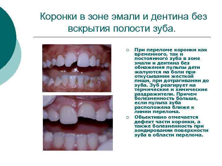 Коронки в зоне эмали и дентина без вскрытия полости зуба. ¡ ¡ При переломе